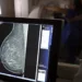 Brasil registrou mais de 108 mil casos de câncer de mama em mulheres com menos de 50 anos entre 2018 e 2023. CBR pede ampliação da faixa etária para mamografia no SUS. Mortalidade cresceu 38% no período.