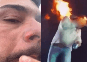 Léo, da dupla sertaneja com Raphael, mostra cicatrizes no rosto após ser atingido por chamas durante show em Pontal (SP). Cantor tranquiliza fãs: “Tá de boa”.