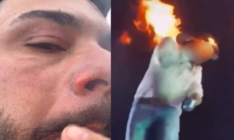 Léo, da dupla sertaneja com Raphael, mostra cicatrizes no rosto após ser atingido por chamas durante show em Pontal (SP). Cantor tranquiliza fãs: “Tá de boa”.