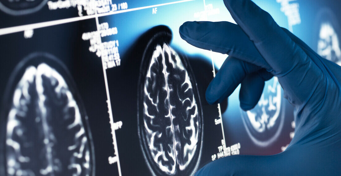 Nova técnica desenvolvida pela Oxford Brain Diagnostics detecta sinais do Alzheimer muito antes dos sintomas surgirem. Inovação é reconhecida como revolucionária por agência dos EUA.