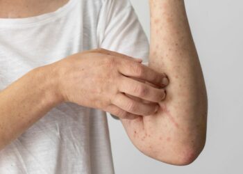 No Dia Mundial da Alergia, a Rede Ebserh alerta para o subdiagnóstico de doenças alérgicas e destaca avanços no diagnóstico e prevenção. Saiba mais sobre sintomas, tipos de alergia e como identificar a doença.