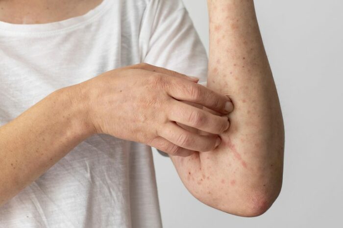 No Dia Mundial da Alergia, a Rede Ebserh alerta para o subdiagnóstico de doenças alérgicas e destaca avanços no diagnóstico e prevenção. Saiba mais sobre sintomas, tipos de alergia e como identificar a doença.
