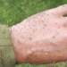 Febre oropouche preocupa o Brasil. Veja o que é mito e o que é verdade sobre transmissão, sintomas e prevenção da doença causada pelo mosquito maruim.