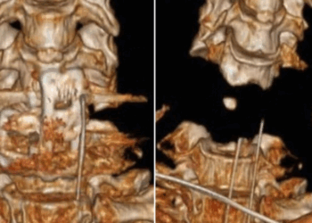 Médicos do Hospital Changzheng, em Xangai, realizaram cirurgia inovadora para reconectar coluna e crânio de homem quase decapitado por braço robótico. Paciente recuperou sinais vitais e consciência após operação de três horas.