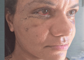 Juliana Garcia dos Santos Soares mostra recuperação após cirurgia de reconstrução facial após ataque violento em Natal. Ex-jogador Igor Cabral é réu por tentativa de feminicídio e segue preso.