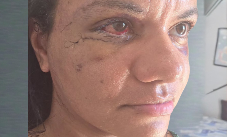 Juliana Garcia dos Santos Soares mostra recuperação após cirurgia de reconstrução facial após ataque violento em Natal. Ex-jogador Igor Cabral é réu por tentativa de feminicídio e segue preso.