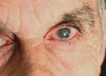 Tecnologia com inteligência artificial desenvolvida no Brasil identifica glaucoma por imagem e promete diagnóstico precoce e acessível.