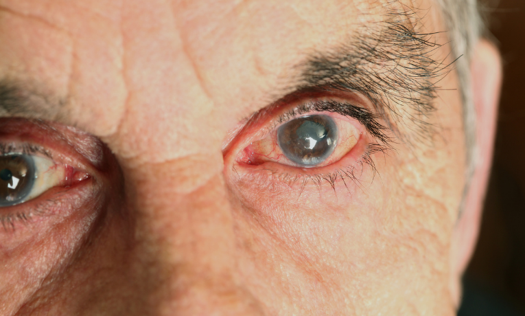 Tecnologia com inteligência artificial desenvolvida no Brasil identifica glaucoma por imagem e promete diagnóstico precoce e acessível.