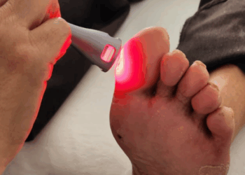 Técnica com luz de LED vem sendo testada em hospitais brasileiros e mostra resultados promissores na recuperação de feridas crônicas, com impacto direto na prevenção de amputações em diabéticos.