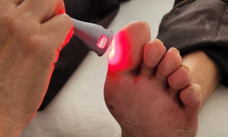 Técnica com luz de LED vem sendo testada em hospitais brasileiros e mostra resultados promissores na recuperação de feridas crônicas, com impacto direto na prevenção de amputações em diabéticos.