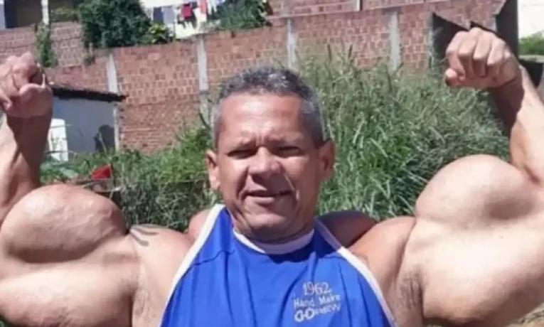 Caso “Popeye Brasileiro” reacende alerta sobre riscos de anabolizantes
