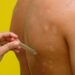 Janeiro Roxo: saiba mais sobre o combate e prevenção à Hanseníase