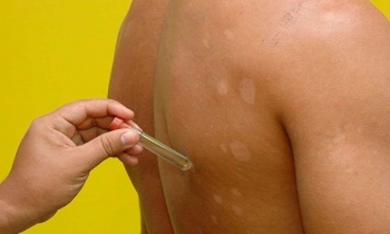 Janeiro Roxo: saiba mais sobre o combate e prevenção à Hanseníase