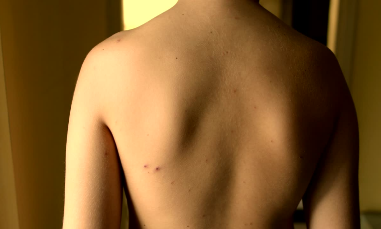Aumento acelerado dos casos de sarampo nas Américas leva Opas a emitir alerta. Maioria das infecções ocorre entre não vacinados.
