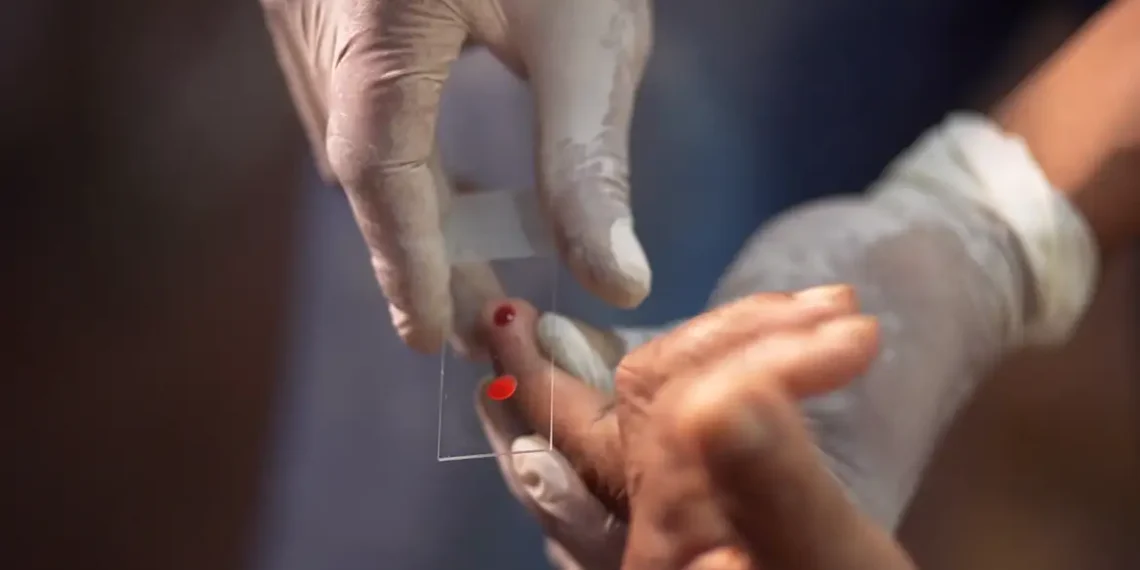 Ministério da Saúde inicia no SUS tratamento contra malária em crianças com tafenoquina pediátrica em dose única. Brasil é o primeiro país a oferecer a terapia.