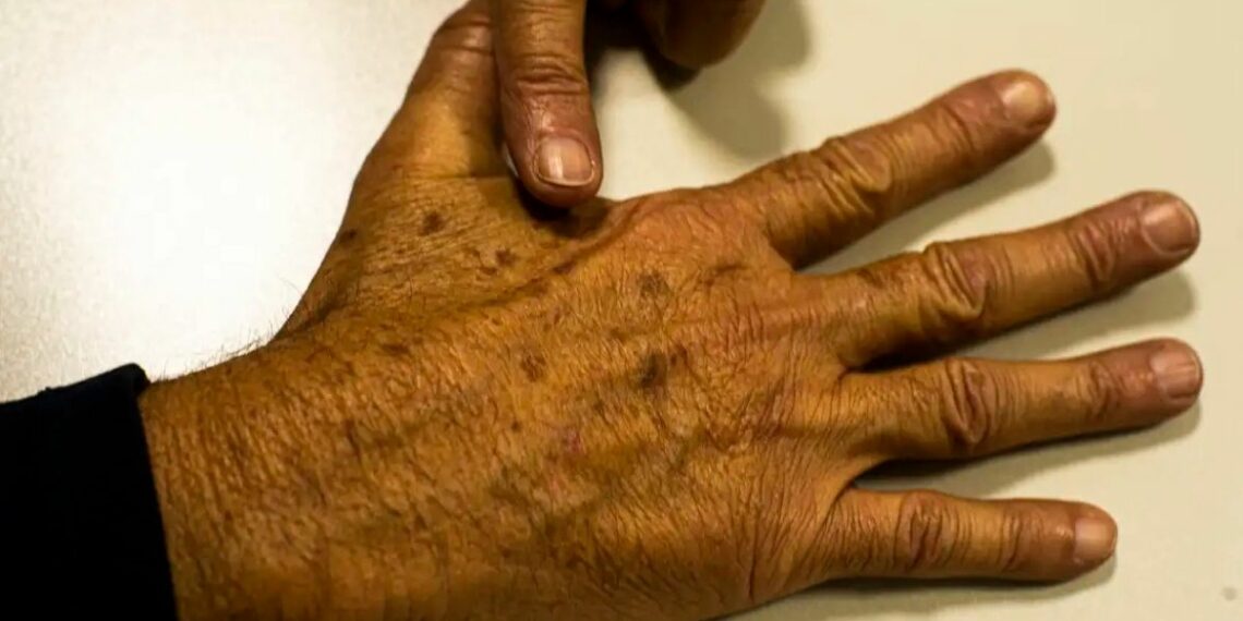 Pesquisa da Fundação do Câncer identifica lacunas em bancos de dados oficiais sobre câncer de pele no Brasil, comprometendo ações de prevenção e diagnóstico precoce.