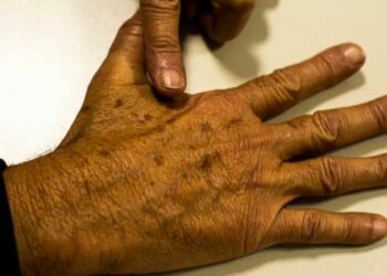 Pesquisa da Fundação do Câncer identifica lacunas em bancos de dados oficiais sobre câncer de pele no Brasil, comprometendo ações de prevenção e diagnóstico precoce.
