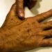Pesquisa da Fundação do Câncer identifica lacunas em bancos de dados oficiais sobre câncer de pele no Brasil, comprometendo ações de prevenção e diagnóstico precoce.