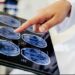 Estudo revela que o álcool pode afetar o Alzheimer de forma diferente conforme a proteína envolvida na doença.