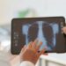 Medicamento inalatório é o primeiro registrado no país para pacientes com hipertensão pulmonar associada à doença pulmonar intersticial.