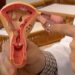 CNPq abre edital de R$ 60 milhões para pesquisas sobre endometriose, dor pélvica e saúde menstrual com foco no SUS. Inscrições até 12 de agosto.