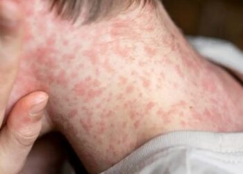 Casos de sarampo aumentam em São Paulo e reforçam alerta sobre vacinação e os riscos de transmissão da doença.