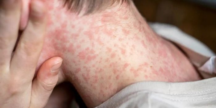 Casos de sarampo aumentam em São Paulo e reforçam alerta sobre vacinação e os riscos de transmissão da doença.
