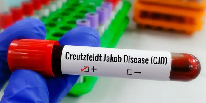 Doença de Creutzfeldt-Jakob é rara e ainda não tem cura. Pesquisadores estudam novos tratamentos e formas mais rápidas de diagnóstico.