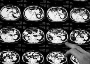 Anvisa aprova o Fruzaqla, medicamento indicado para pacientes adultos com câncer colorretal metastático que já passaram por outros tratamentos.