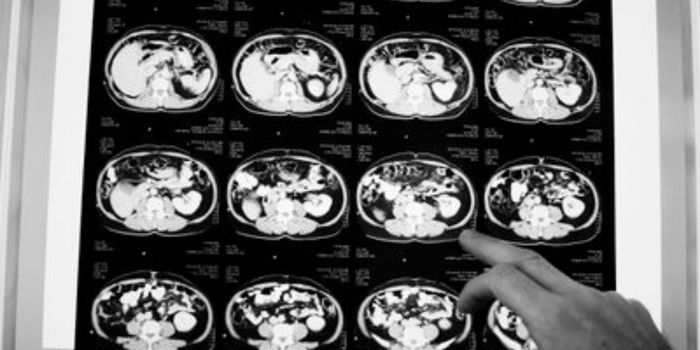 Anvisa aprova o Fruzaqla, medicamento indicado para pacientes adultos com câncer colorretal metastático que já passaram por outros tratamentos.