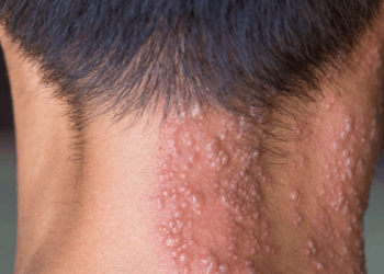 Vacina contra herpes-zóster poderá entrar no calendário do SUS se projeto aprovado em comissão do Senado concluir a tramitação no Congresso.
