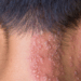 Vacina contra herpes-zóster poderá entrar no calendário do SUS se projeto aprovado em comissão do Senado concluir a tramitação no Congresso.