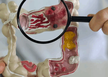 Estudo apresentado em congresso aponta aumento das doenças inflamatórias intestinais no Brasil e prevê crescimento dos casos até 2035.