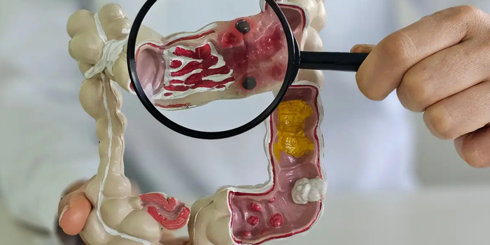 Estudo apresentado em congresso aponta aumento das doenças inflamatórias intestinais no Brasil e prevê crescimento dos casos até 2035.