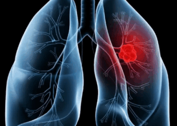 O diagnóstico de adenocarcinoma pulmonar associado ao caso do papa Leão XIV destaca sintomas, fatores de risco, exames e possibilidades de tratamento.