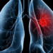O diagnóstico de adenocarcinoma pulmonar associado ao caso do papa Leão XIV destaca sintomas, fatores de risco, exames e possibilidades de tratamento.