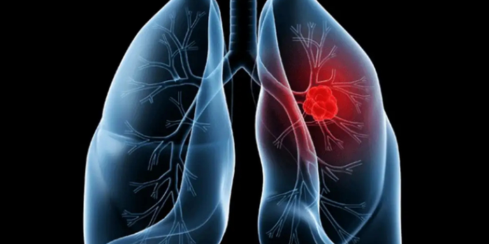 O diagnóstico de adenocarcinoma pulmonar associado ao caso do papa Leão XIV destaca sintomas, fatores de risco, exames e possibilidades de tratamento.